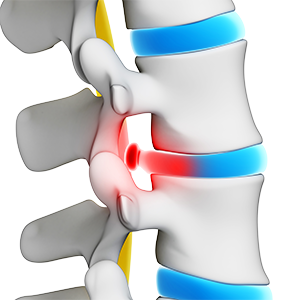 Herniated and Bulging Disc