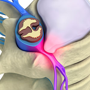 Spinal Stenosis